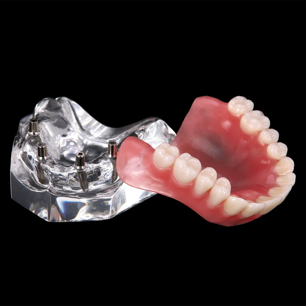 Hot Selling Dental Implant Teeth Model Overdenture Restoration with Implants Upper