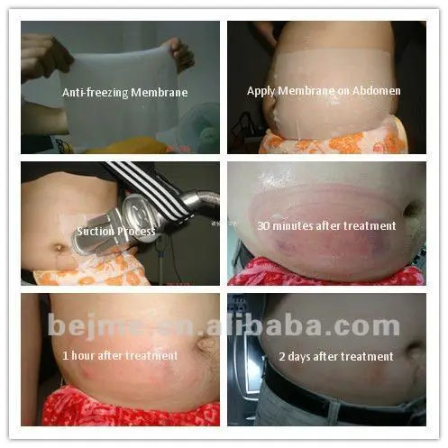 Good Quality Wholesale 60g/70g/110g big Size Skin Cryo Anti-freeze Cryolipolysis Gel Protection Membrana for Beauty