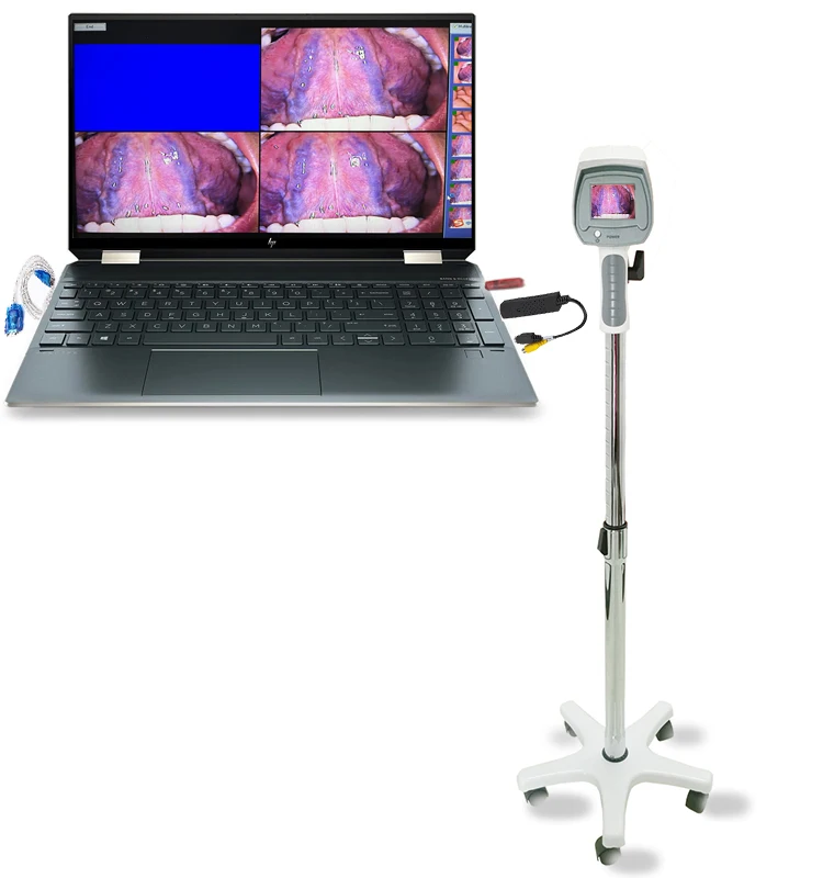 Cheap Price Hospital Gynecology Digital Video System Endoscope Colposcope