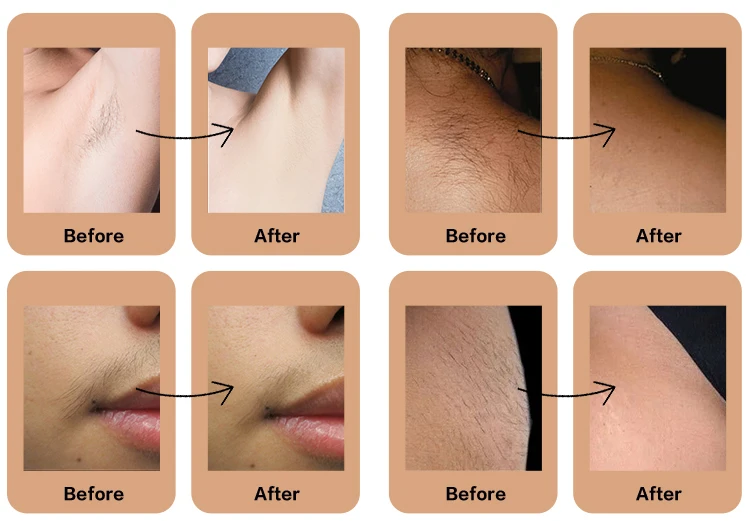 titanium hair laser (5)