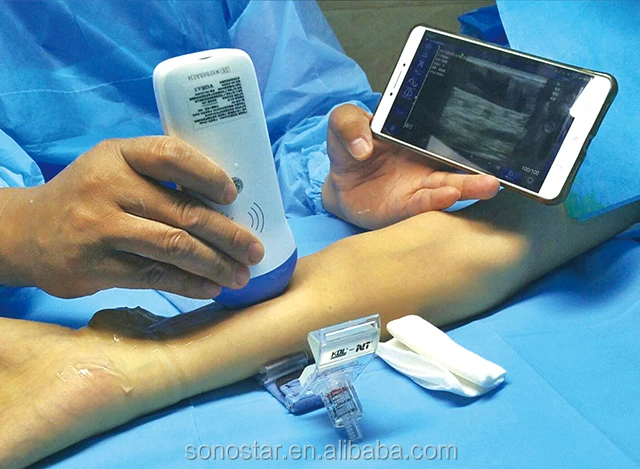 PICC / CVC Use Wireless Ultrasound Scanner Needle Guide for Vein Puncture in Guangzhou