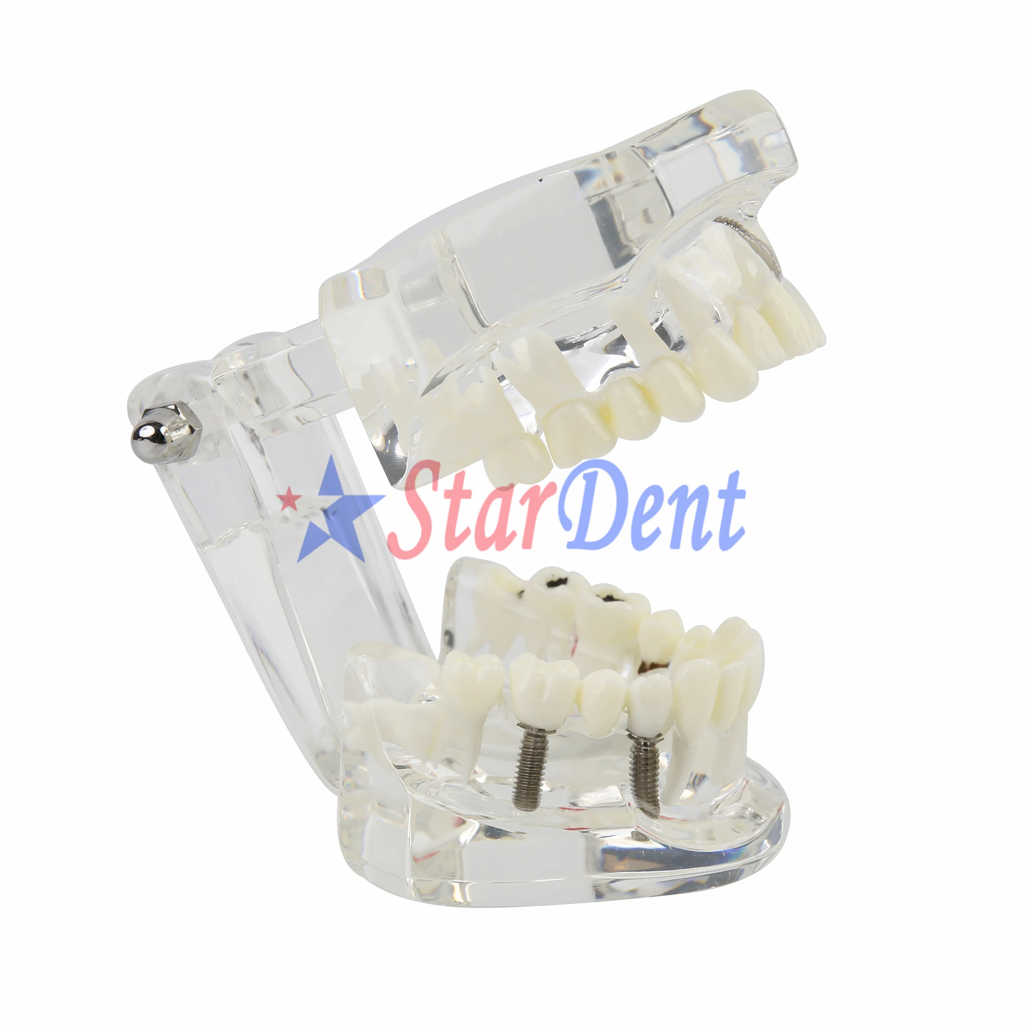 Зубные зубы модель имплантата для зубного