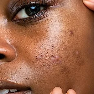 39 Dots Cosmetics Invisible+ Hydrocolloid Daytime Ultra Thin Acne Pimple Patches (24 Medium and 15 Small Patches) wholesale