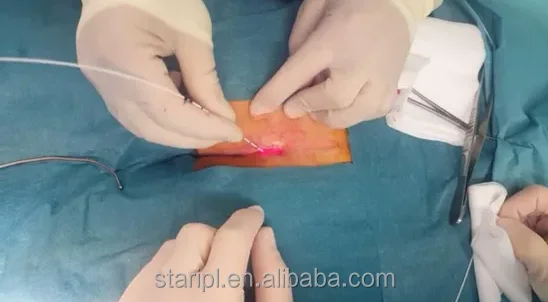 Surgery no Bleeding 1470nm Proctology Hemorrhodis Fistula Laser Sugery Machine With 600um Radial Fiber 600um Conical Fiber