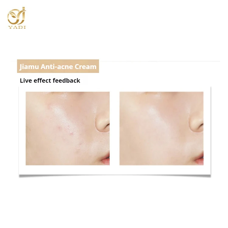 China maker wholesale products Repair anti-acne set lady facial cream hyaluronic acid Phellodendron