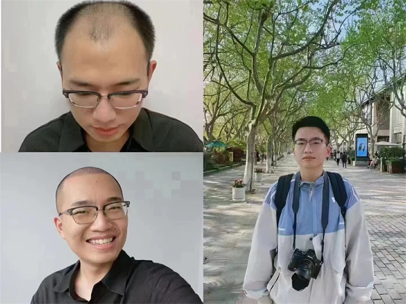 Regeneration hair growth freeze-dried powder stem cell factor hair repair anti-hair loss peptide solution natural scalp essence