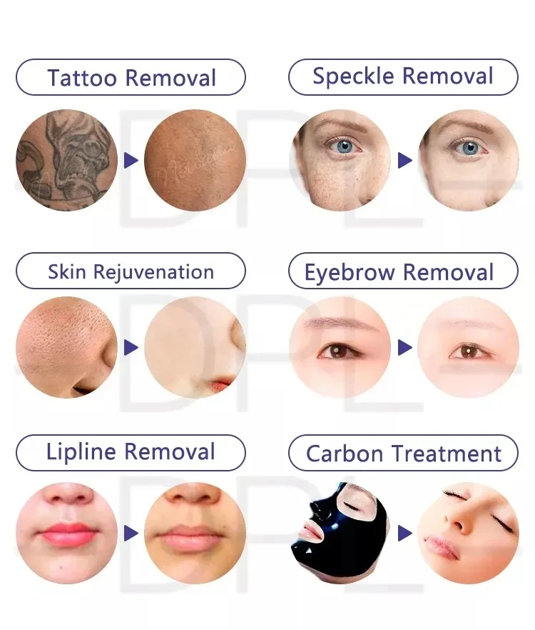 Портативный Пико-второй лазерный прибор для удаления тату