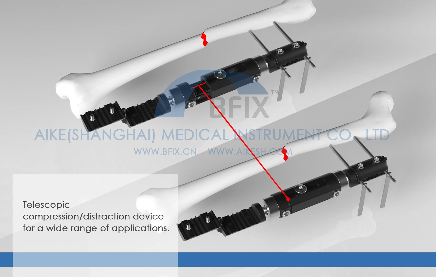 
Bfix Orthopedic Micro Movement Limb Reconstruction External Fixator System 