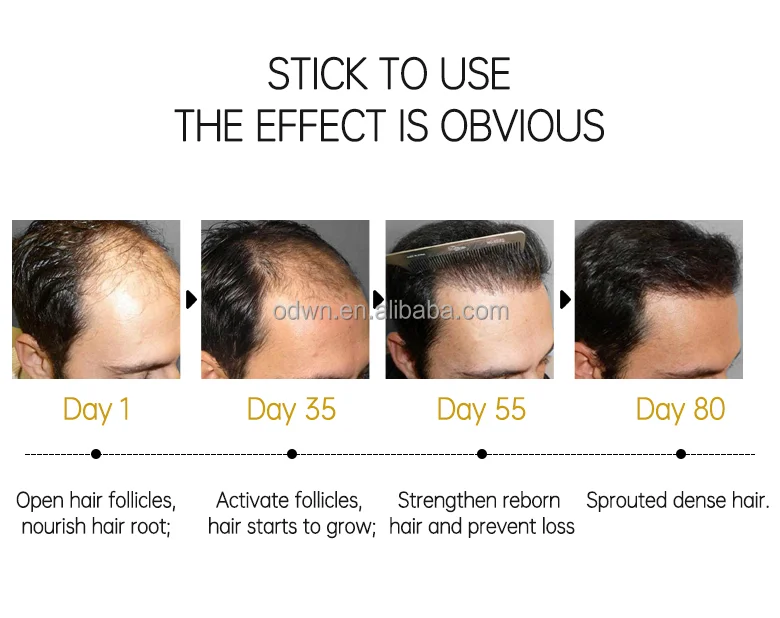 100% Guaranteed Satisfaction Ginger Oil Hair Growth Oil For Men Women Hair Growth