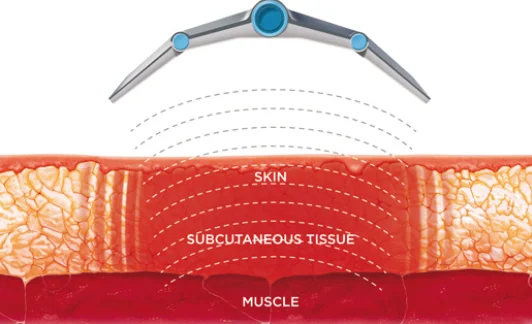 Best Selective radio frequency weight loss field Tuning real-time monitoring slim machine
