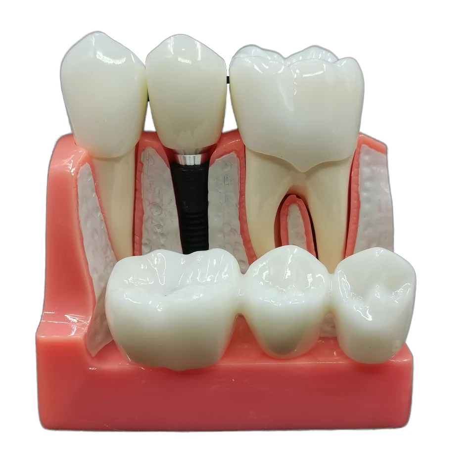 Модель зубного импланта 2 5 раз демонстрационные модели Crown Bridge Abutment съемная стоматологическая клиника инструменты