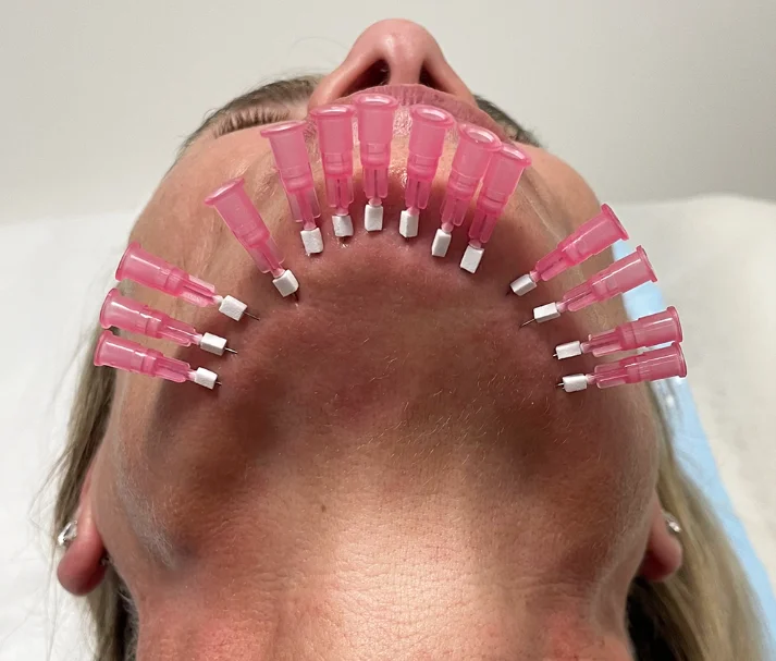 Face Lifting Threads Hilos 4d pdo cone adhesive for pdo thread mesh