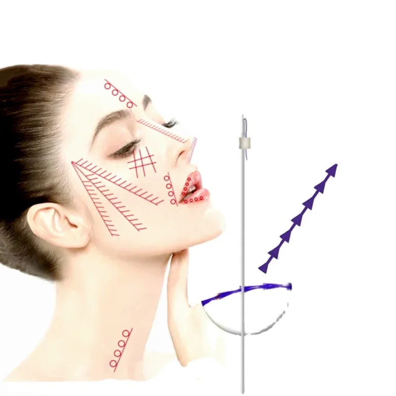 Thread Wholesale Beauty Equipment Pdo pcl plla Lifting Thread 3d Lift Needle