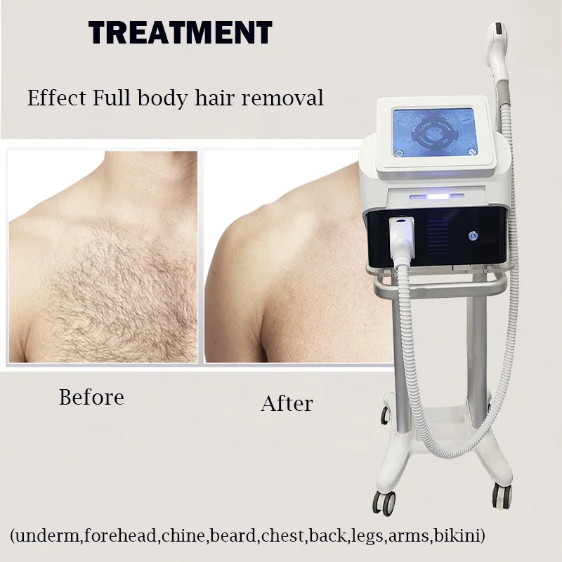 808 1064 nm diode laser epilator for hair removal equipment Medical 808 1064 diode laser hair removal machine price