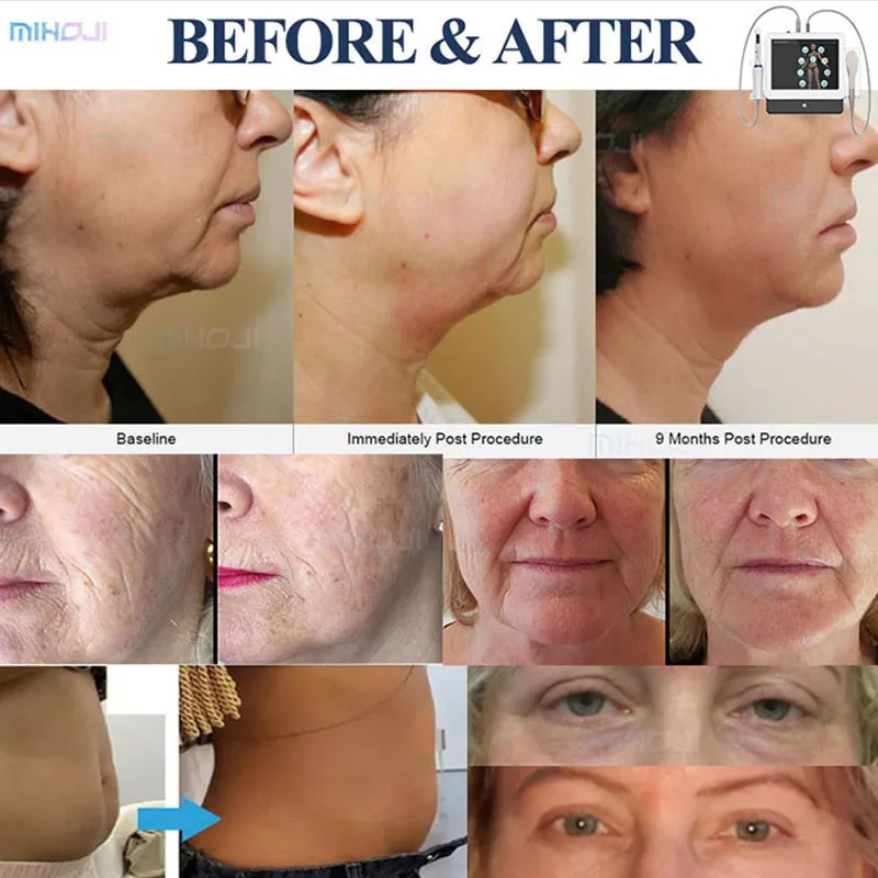 hifu 9d professional use machine hifu 12d vagina hifu machine