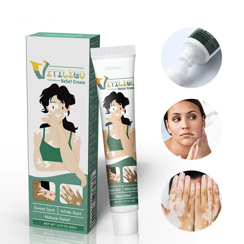 Vitiligo Cream Get rid of ringworm White spots Get rid of skin vitiligo Eliminate vitiligo