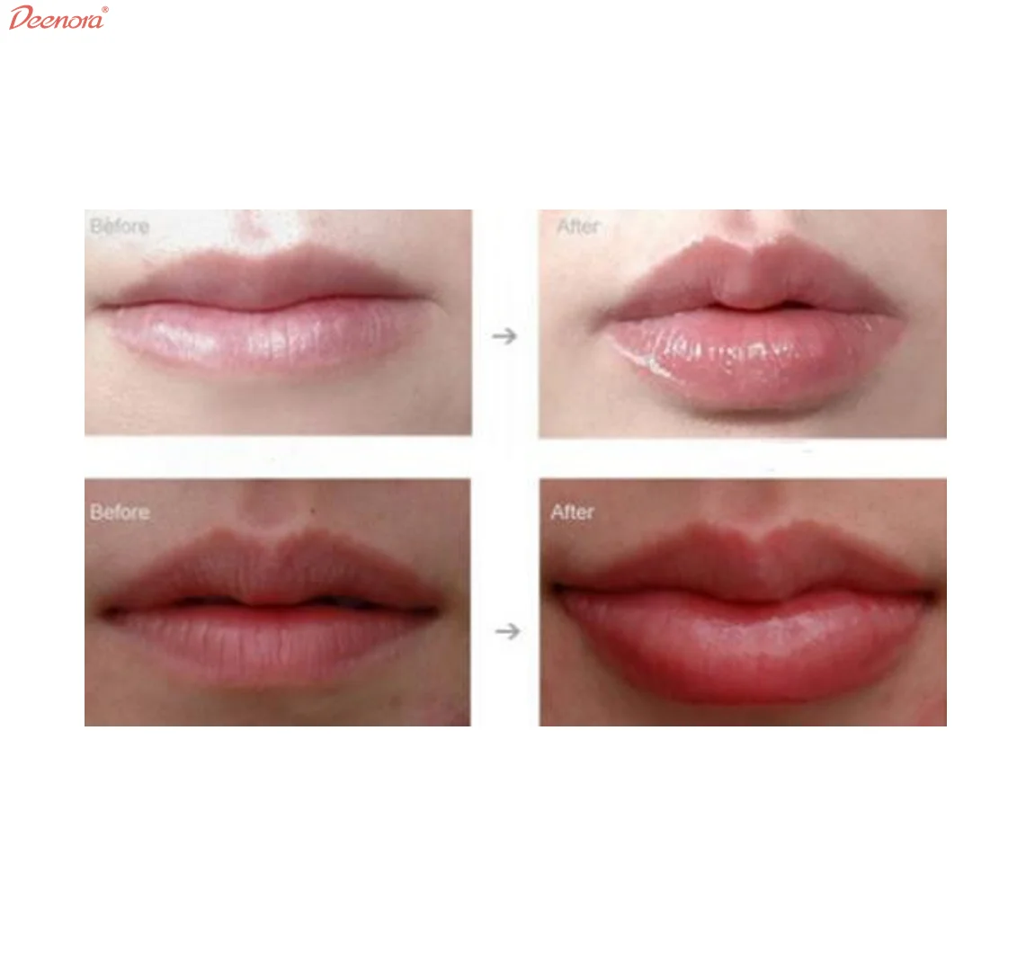 Deenora 2 boxes long lasting injection injectable acido hialuronico dermal filler for nose face penis enlargement