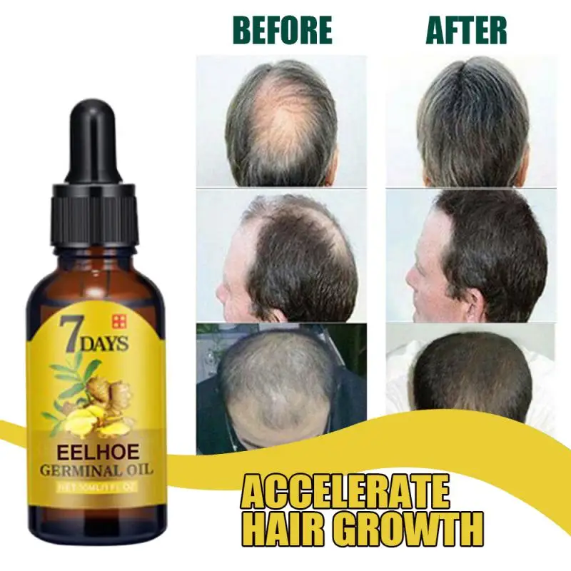  Pro Ginger тоник для волос Hair OilTreatment быстро растущий питательный и увлажняющий уход за