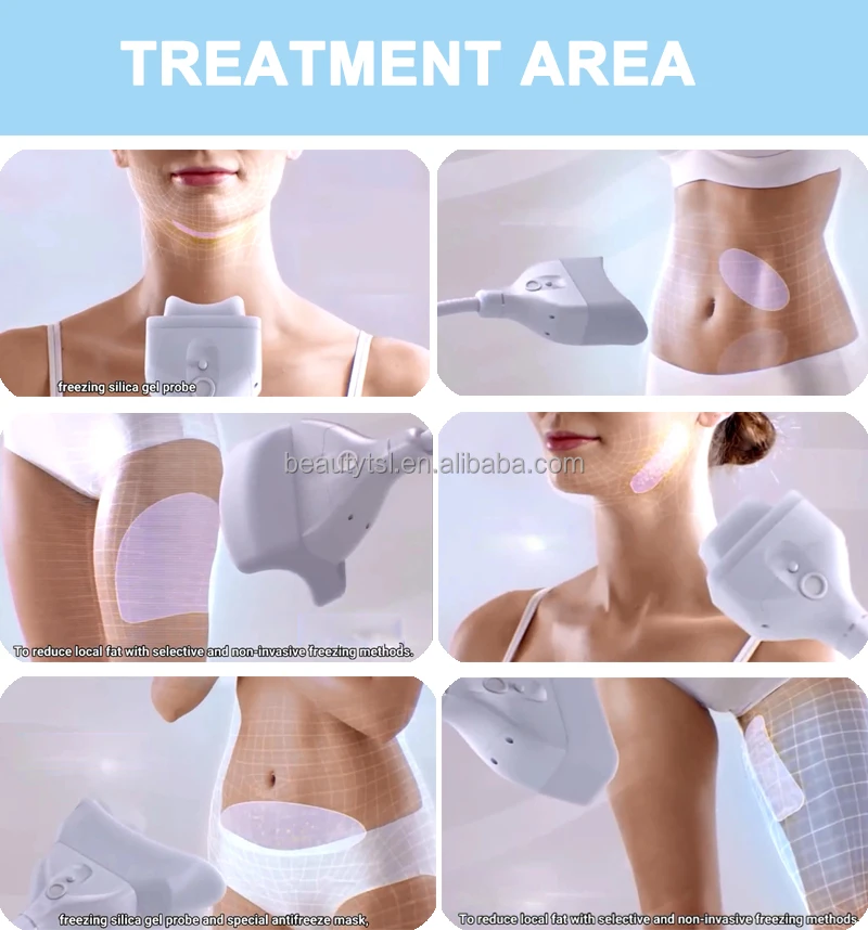 TSL-1102A cryolipolysis 26.jpg