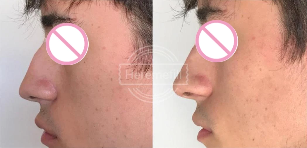 Heremefill Cross-Linked Hyaluronic Acid Dermal Filler Body Nose Face Lip Enhancement Fillers