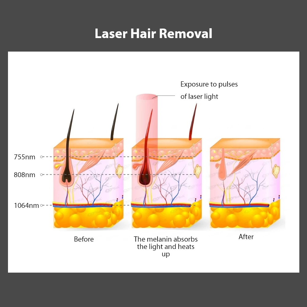 Portable 755 808 1064 beauty center prefer ice laser diode laser hair removal machnie