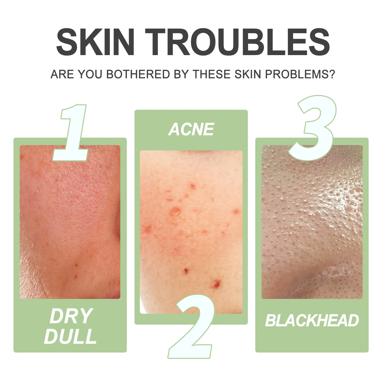 private label oem custom logo  Acid Facial Exfoliating Gel Deep clear pores blackheads Acne Whitening Skin Gel