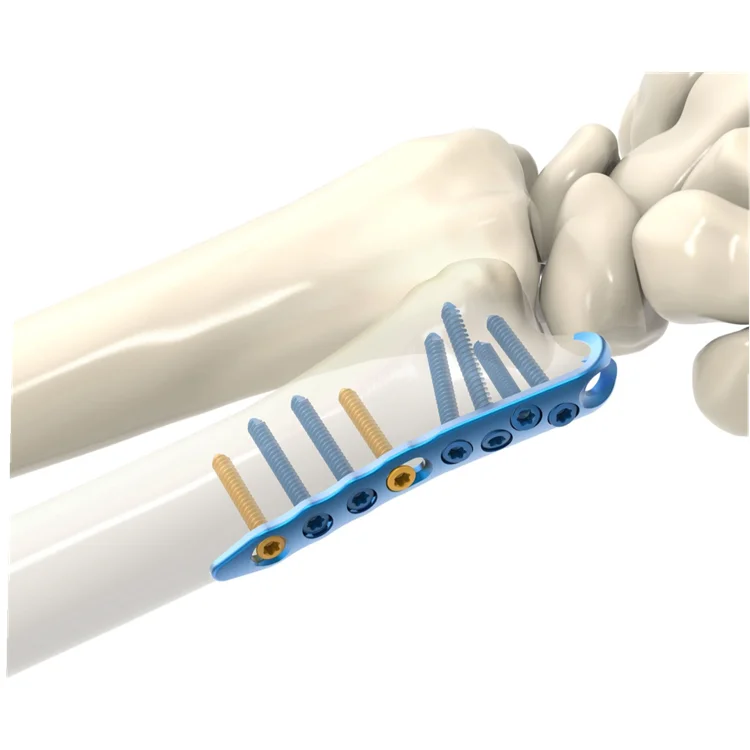 Orthopedic Implants Locking Plate Lcp Distal Ulna Radius Compression Locking Plate