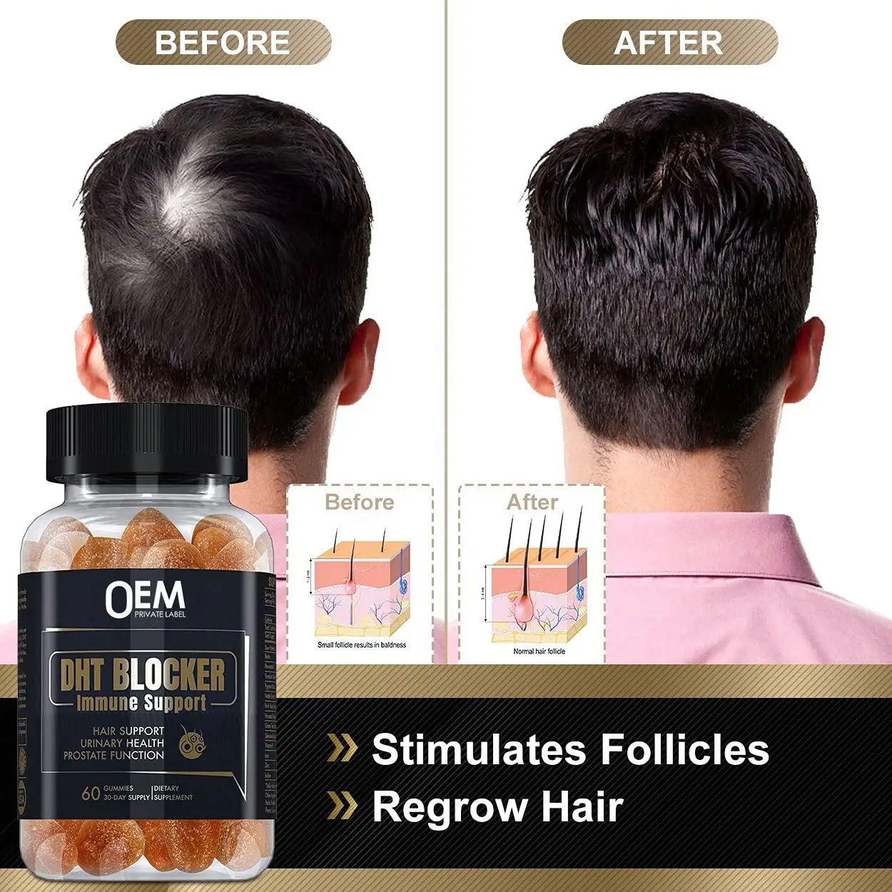 Private Label DHT Blocker Gummies Biotin Hair Vitamins for Men Women Hair Growth Supplements