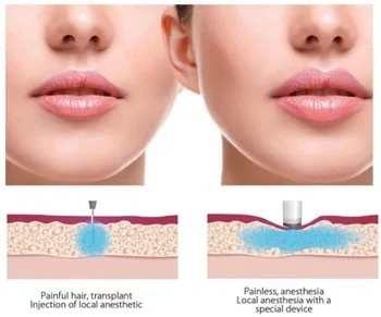 
microneedle machine frozen skin meso mesotherapy gun hyaluronic pen gun no needle injector mesoterapia new beauty 