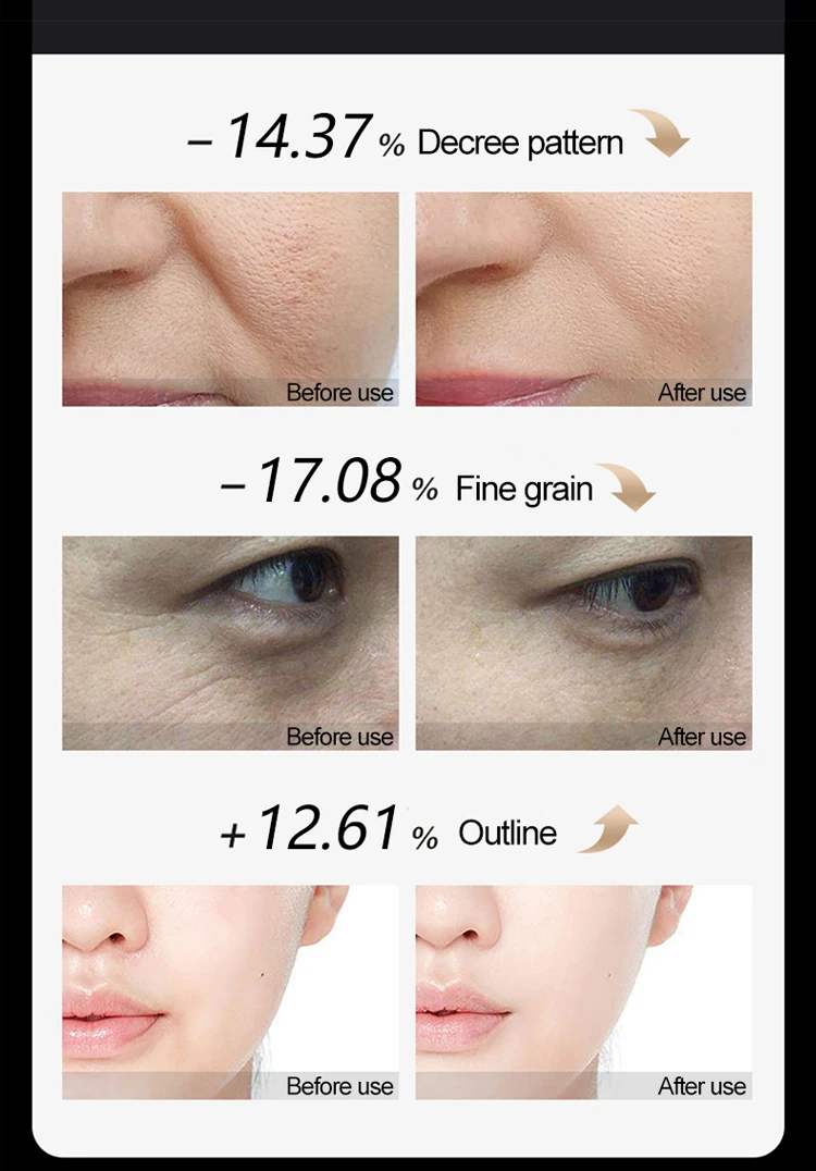 New Updated Rf Handhold Device For Wrinkle Removal And Skin Rejuvenation 22 Fractional Radio Frequency Guides Aged 24 To 50