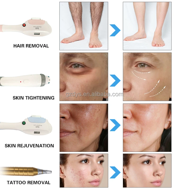 4 in 1 Multifunction q switched nd yag laser rf machines elight opt ipl hair removal diode laser hair removal machine pico