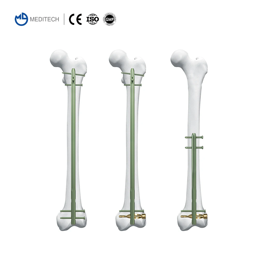 MEDITECH Interlocking Nail System Expert R/AFN. Retrograde /Antegrade Femoral Nail Titanium Orthopedic Surgical Trauma Implants