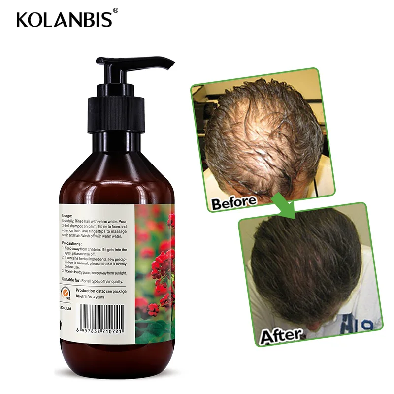 300ml Shampoo For Hair Loss Treatment Hair Growth Products With No Side Effects