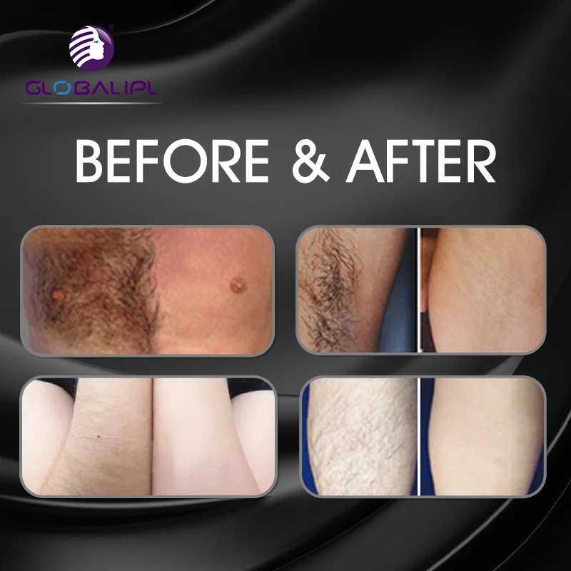 Permanent painfree laser diode 755 808 1064 Hair Removal Machine Diode Laser 808nm