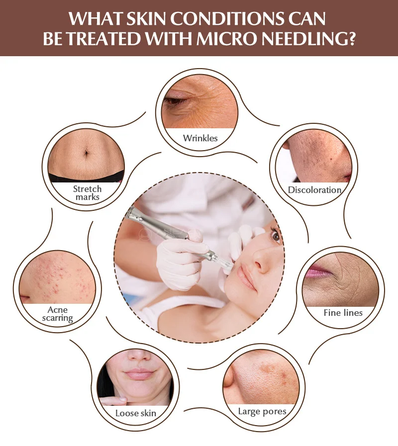 new powfule wireless E30 5 levels speed microneedle system ultima BB glow pen korea derma pen microneedling nano needle dr.pen