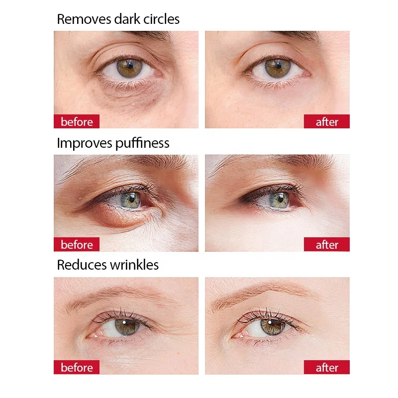 Private Label Anti Dark Circles Remove Wrinkle Cream Eye Whitening Products