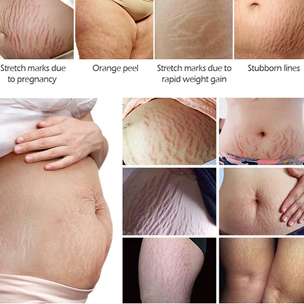 Natural Mild Non-irritating Remove Stretch Mark Cream for Pregnancy Repair Scar Slack Line Abdomen Stretch Marks Cream