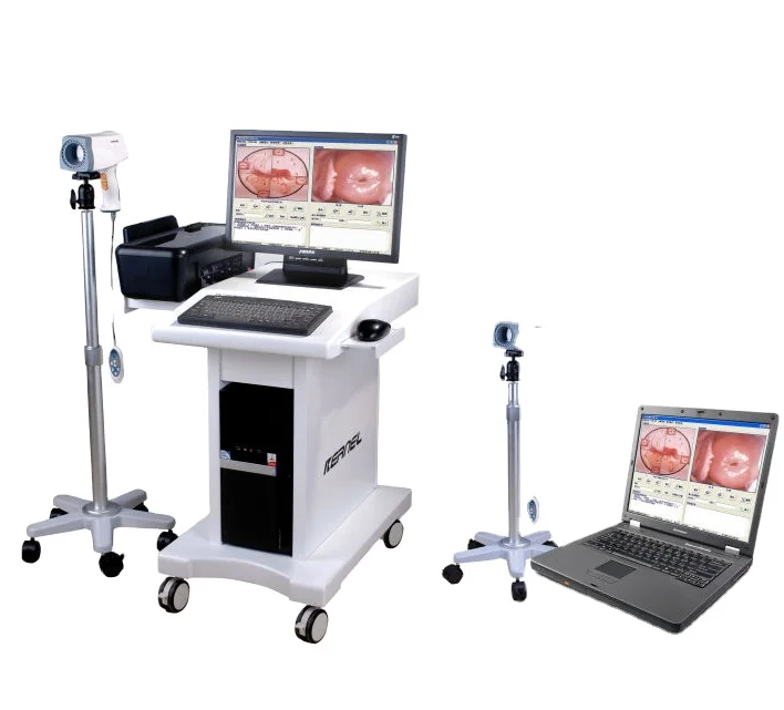 Digital HD Video Mini Electronic Colposcope High Definition Camera Digital Colposcope Colposcopy and Biopsy