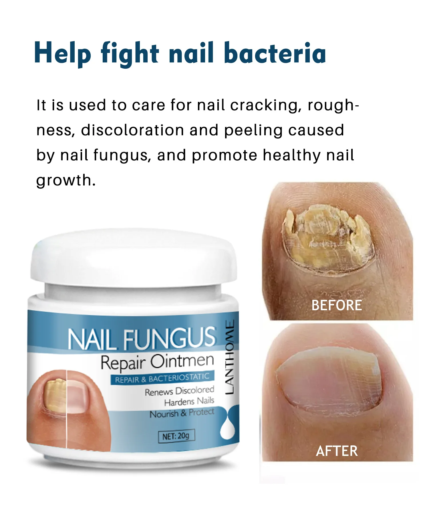 OEM Nail Onychomycosis Fungal Treatment Foot Cream Fungus Removal Cream Paronychia Anti Infection Nails Fungus Repair Ointment