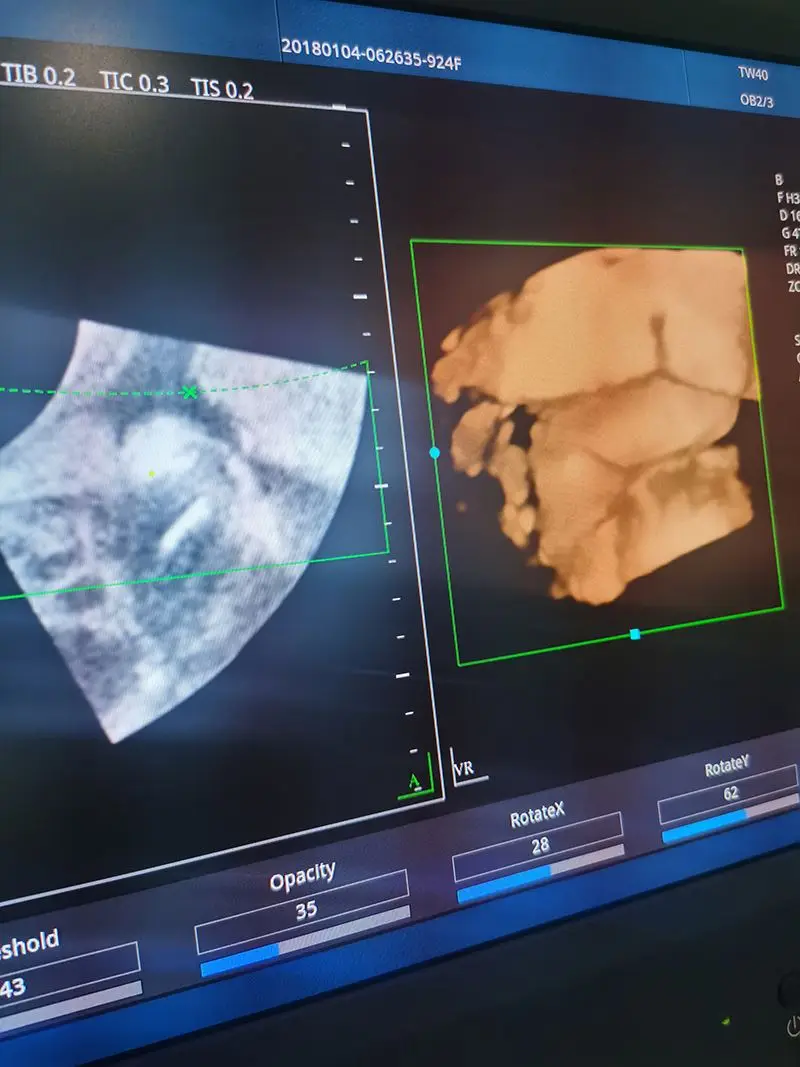 Медицинская ультразвуковая 3D 4D цветная допплеровская диагностическая система Medsinglong MSLCU46