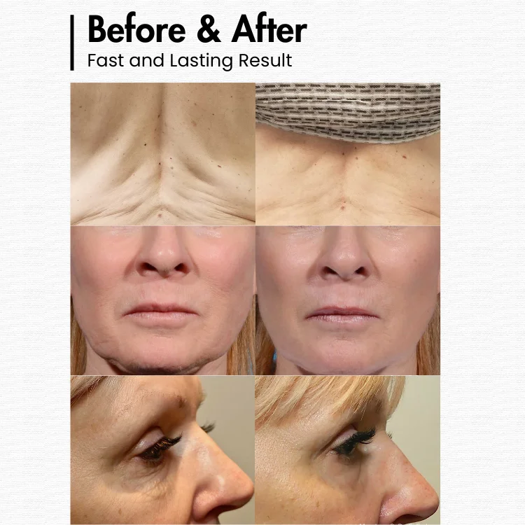 Adjustable depth fractional rf for face lifting acne treatment skin tightening high reuqency facial anti-wrinkles device