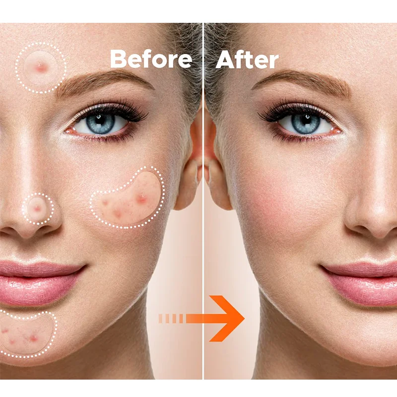 Cosmetics Vegan Hydrocolloid Spot Stickers Acne Patch Custom Logo Private Label Acne Patch