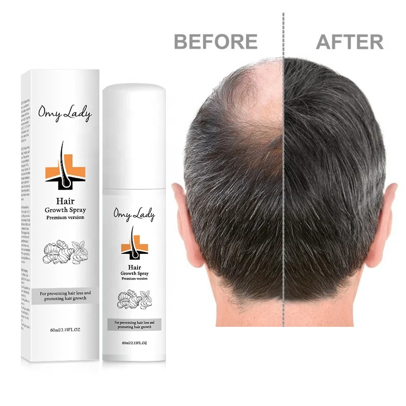 Omy Lady Hair Growth oil  Bulk Neo Lotion Growth Hair spay for anti hair loss