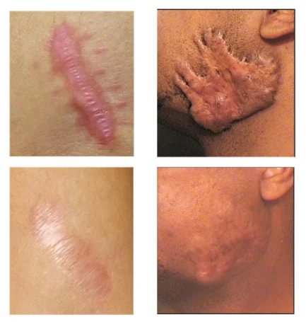 Acne Scar Removal Gel Treatment Surgical Scald Repair Cream Fade Dark Skin Pigmentation Postpartum Whitening Smooth Skin Care