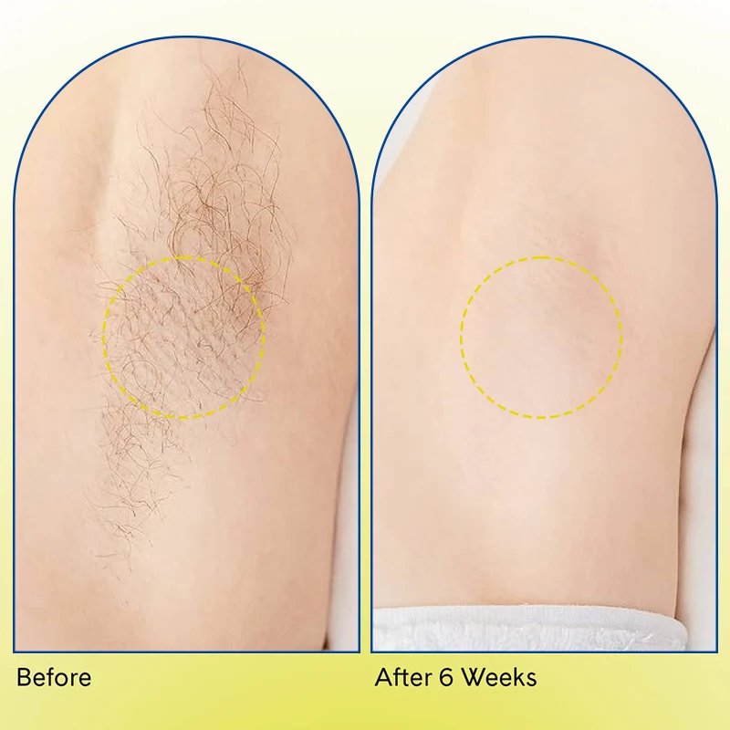 Private Label Ingrown Hair Stopper Eliminator Lactic Acid Witch Hazel Balance Smooth Ingrown Hair Serum Spray