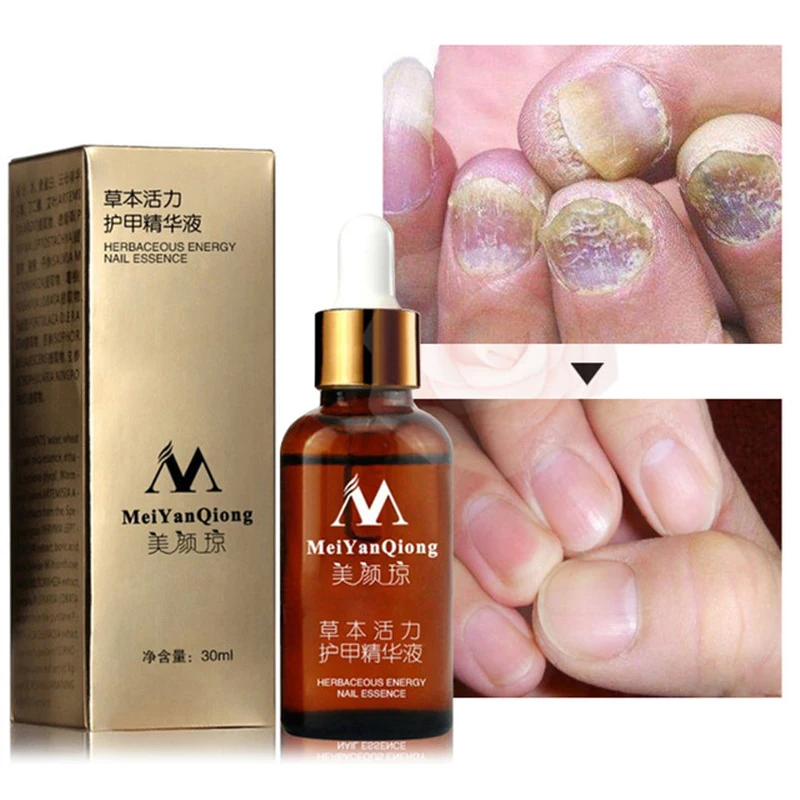 Fungal Nail Treatment Feet Care Essence Nail Foot Whitening Toe Nail Fungus Removal Gel Anti Infection Paronychia Onychomycosis