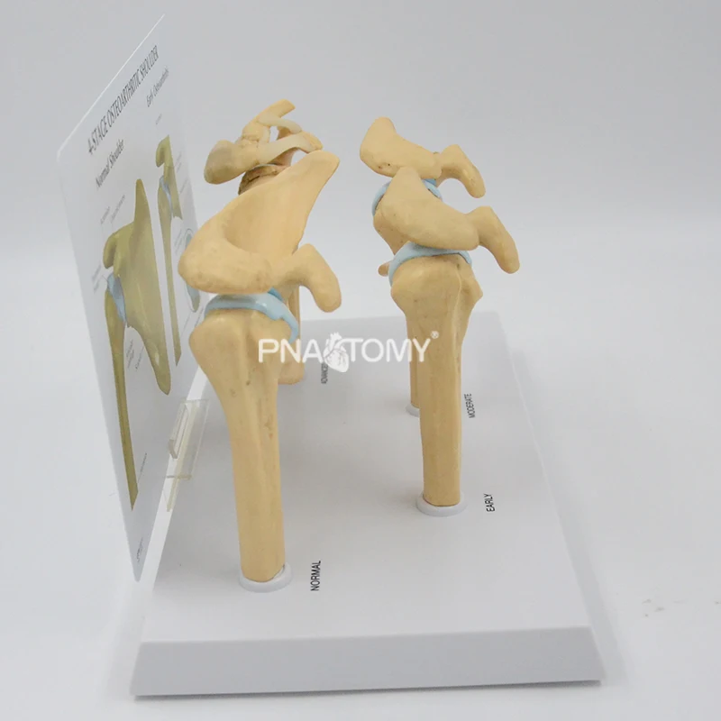 4-STAGE OSTEOARTHRITIS (OA) SHOULDER ANATOMY MODEL HUMAN SKELETON ANATOMICAL MODEL TEACHING RESOURCES EDUCATIONAL EQUIPMENT