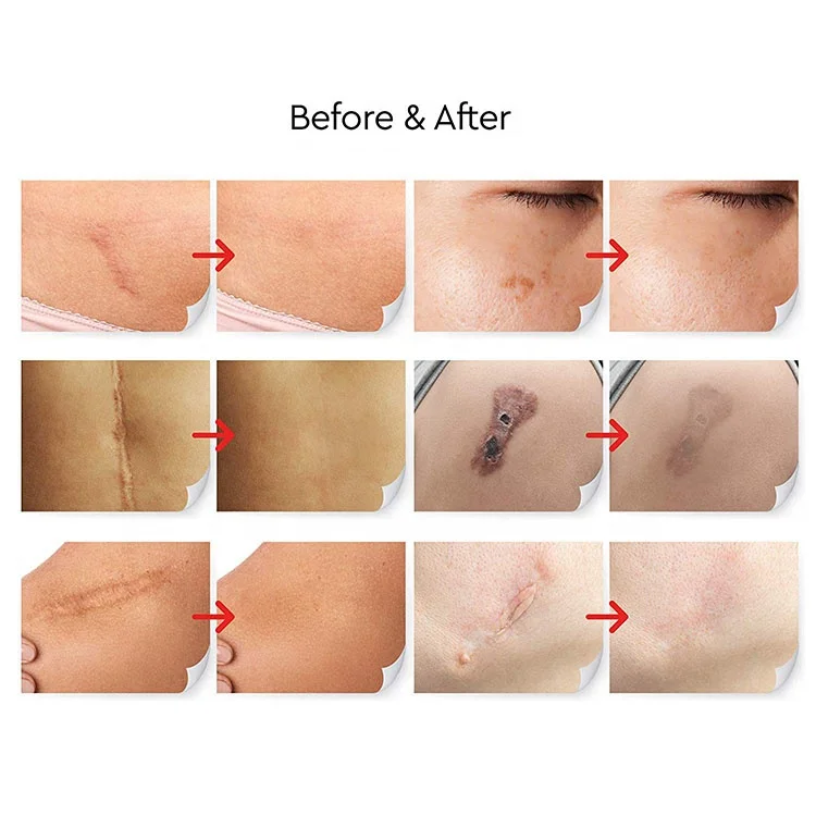 Private Label Deep Acne Scar Removal Cream for Old Scars Stretch Marks