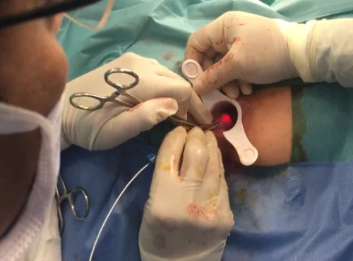 hemorrhoids laser.png