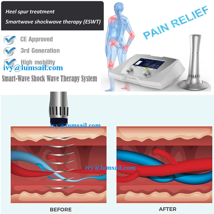 Smartwave Shockwave Therapy Physical Device for Excessive Underarm Sweating (Hyperhidrosis) and armpit treatment